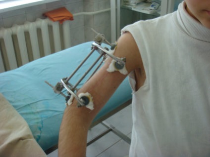 tipuri și caracteristici osteoplasty (tipuri) Grefării osoase, tipuri și caracteristici