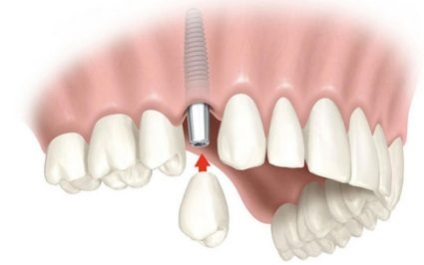 tipuri și caracteristici osteoplasty (proces maxilar) Grefării osoase, tipuri și caracteristici