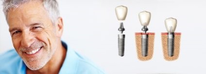 tipuri și caracteristici osteoplasty (osoase) Grefării osoase, tipuri și caracteristici