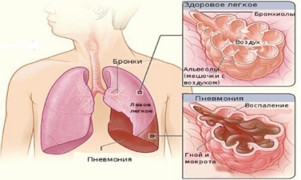 simptome pneumonie lobară, cauze, tratament