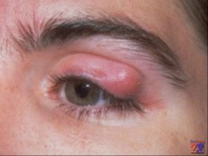 Tratamentul șalazion - normale, aleatoare, populară, homeopatie (șalazion) Tratamentul șalazion - normale, aleatoare, popular, homeopatie
