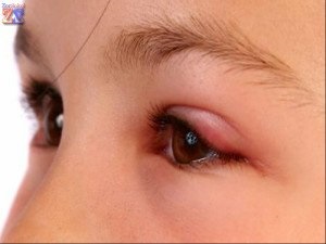 șalazion Tratamentul - normale, operativ, popular, homeopatie (tratament) Tratamentul șalazion - normale, aleatoare, popular, homeopatie