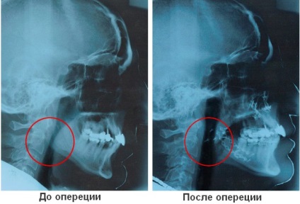 Sforăitul tratament prin chirurgie - indicații și tipurile de operațiuni de la sforăit, rezultatul