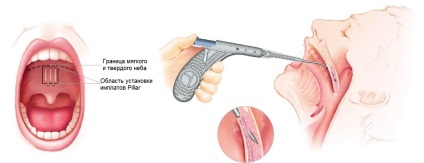Sforăitul tratament prin chirurgie - indicații și tipuri de operații de la sforăit, rezultatul (sforăit) Sforăitul tratament prin chirurgie - indicații și tipurile de operațiuni de la sforăit, rezultatul
