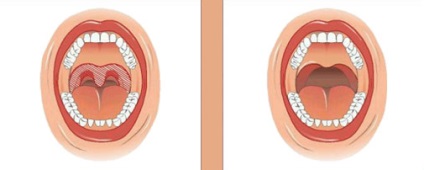 Sforăitul tratament prin chirurgie - indicații și tipuri de operații de la sforăit, rezultatul (citire) Sforăitul tratament prin chirurgie - indicații și tipurile de operațiuni de la sforăit, rezultatul