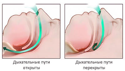 Sforăitul tratament prin chirurgie - indicații și tipuri de operații de la sforăit, conexiunea (operația sforăitul răspunsurilor) rezultat Sforăitul tratament prin chirurgie - indicații și tipurile de operațiuni de la sforăit, rezultatul