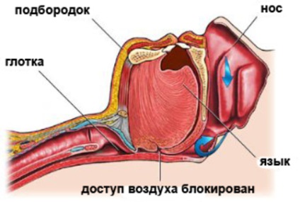 Sforăitul tratament prin chirurgie - indicații și tipuri de operații de la sforăit, rezultatul (tratament) Sforăitul tratament prin chirurgie - indicații și tipurile de operațiuni de la sforăit, rezultatul