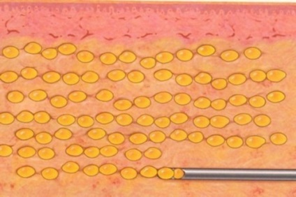 buze lipofilling (corecție de grăsime) - o procedură, prețuri, recenzii, fotografii (buze lipofilling) buze lipofilling (corecție de grăsime) - o procedură, prețuri, comentarii, fotografii