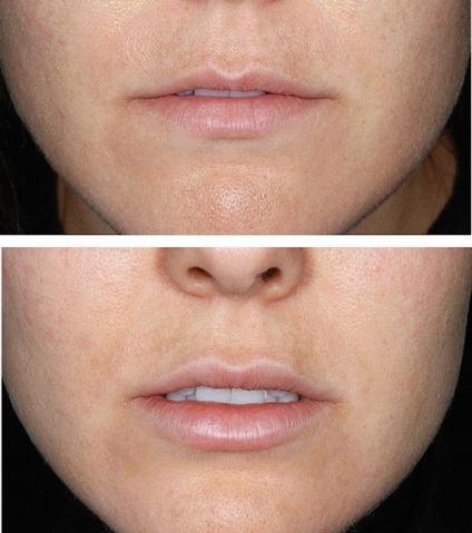 buze lipofilling (corecție de grăsime) - o procedură, prețuri, recenzii, fotografii (procedură) buze lipofilling (corecție de grăsime) - o procedură, prețuri, comentarii, fotografii