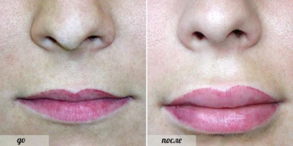 buze lipofilling (corecție de grăsime) - o procedură, prețuri, recenzii, fotografii (comentarii) buze lipofilling (corecție de grăsime) - o procedură, prețuri, comentarii, fotografii
