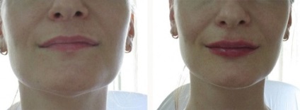 buze lipofilling (corecție de grăsime) - o procedură, prețuri, recenzii, fotografii (grăsime) buze lipofilling (corecție de grăsime) - o procedură, prețuri, comentarii, fotografii