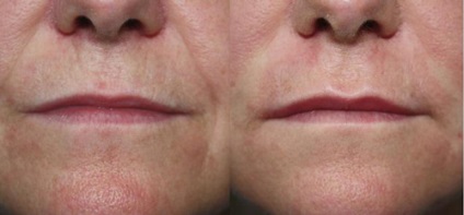 buze lipofilling (corecție de grăsime) - o procedură, prețuri, recenzii, fotografii (procedură) buze lipofilling (corecție de grăsime) - o procedură, prețuri, comentarii, fotografii