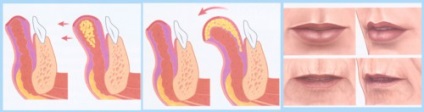 buze lipofilling (corecție de grăsime) - o procedură, prețuri, recenzii, fotografii (grăsime) buze lipofilling (corecție de grăsime) - o procedură, prețuri, comentarii, fotografii