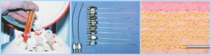 buze lipofilling (corecție de grăsime) - o procedură, prețuri, recenzii, fotografii (comentarii) buze lipofilling (corecție de grăsime) - o procedură, prețuri, comentarii, fotografii