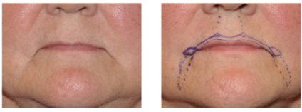 buze lipofilling (corecție de grăsime) - o procedură, prețuri, recenzii, fotografii (grăsime) buze lipofilling (corecție de grăsime) - o procedură, prețuri, comentarii, fotografii