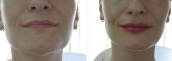 buze lipofilling procedură specifică, prețul și clienți (după procedura lipofilling) buze lipofilling procedură specială, preț și recenzii