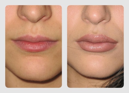 Lipofilling buzelor comentarii, fotografii înainte și după (după) Lipofilling buzelor comentarii, fotografii înainte și după