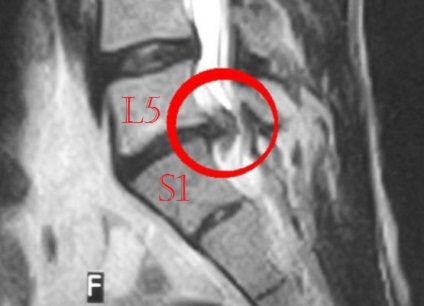 hernie de disc Mediana (L5 l4, l5 s1 etc.