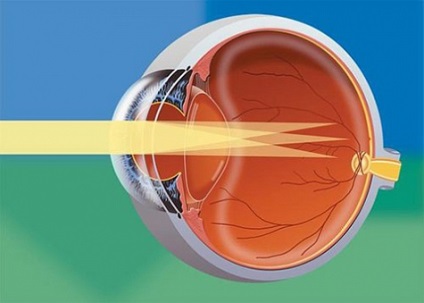 astigmatismul miop de ambii ochi, tratamentul astigmatismului miopic compus in clinica (miop) astigmatism miopic în ambii ochi, tratamentul compusului astigmatism miopic în clinică