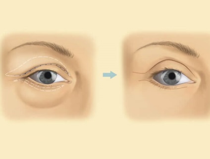 Simula cutelor special chirurgie (cutelor) Simula pliului special chirurgie