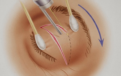 Simula cutelor special chirurgie (cutelor) Simula pliului special chirurgie