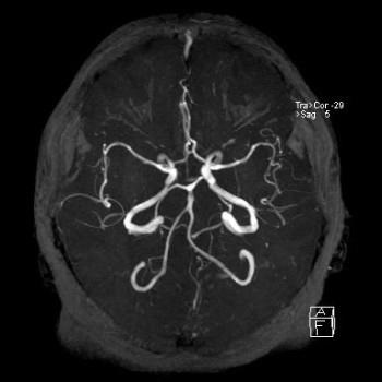 Diagnosticul IRM a vaselor cerebrale (angiografie) - Descrierea și adresele de clinici (cap) Diagnosticul IRM a vaselor cerebrale (angiografie) - Descrierea și adresele clinici
