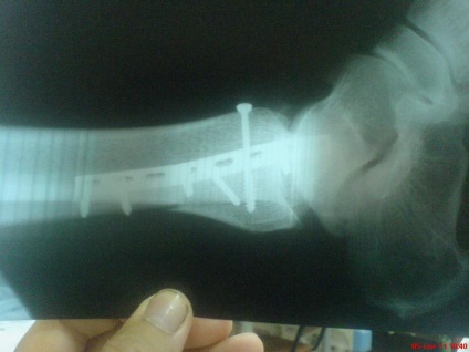 Un pic despre titan poate cineva veni la îndemână în experiența mea (spital) Un pic despre titan poate cineva veni la îndemână în experiența mea