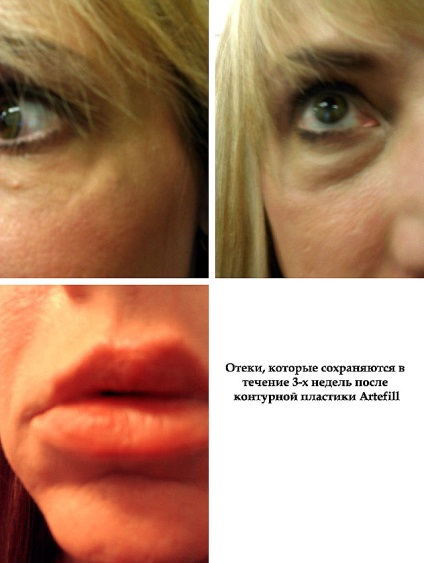 Backfire conturare și cum să evite complicațiile (complicații după conturare efecte de prevenire) Backfire conturare și cum să evite complicațiile