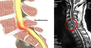 1 instabilitate a coloanei vertebrale (instabilitatea coloanei cervicale) Instabilitatea coloanei vertebrale 1