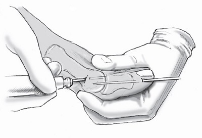 Încălțăminte (încălțăminte) Baruka - încălțăminte ortopedică postoperatorie (postoperator) Încălțăminte (încălțăminte) Baruka - ortopedică postoperatorii