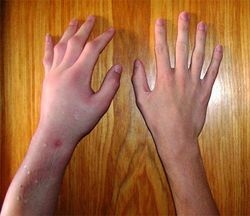 Umflarea mâinilor și zgâriat de ce mult și ce să faceți dacă sunteți alergic (umflate) Umflarea mâinilor și zgâriat de ce de mult și ce să faceți dacă sunteți alergic