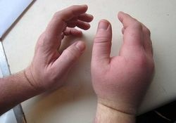 Umflarea mâinilor și zgâriat de ce mult și ce să faceți dacă sunteți alergic (mâncărime) Umflarea mâinilor și zgâriat de ce de mult și ce să faceți dacă sunteți alergic
