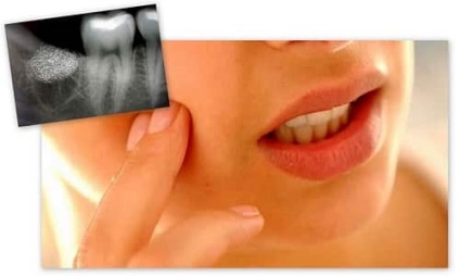 Complicațiile după cauze de extracție dentară și ce să facă (după) Complicațiile după extracția dentară și cauzele ce să facă