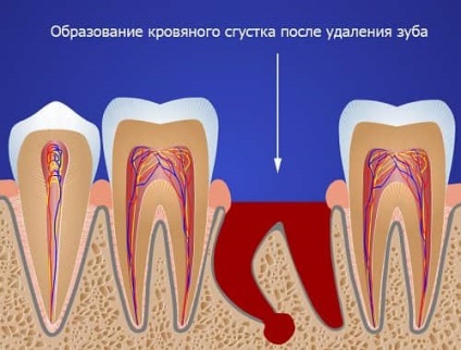 Complicațiile după cauze de extracție dentară și ce să facă (după) Complicațiile după extracția dentară și cauzele ce să facă