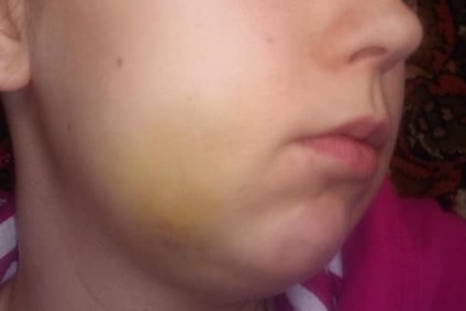 Complicațiile după cauze de extracție dentară și ce să facă (după) Complicațiile după extracția dentară și cauzele ce să facă