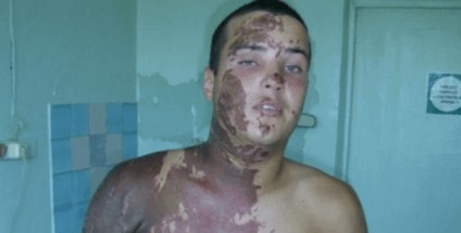Sulfuric semne și simptome de otrăvire acidă, prim ajutor (otrăvire) Sulfurici semne și simptome de otrăvire de acid, prim ajutor