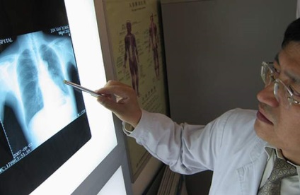 Primele semne de cancer pulmonar ohmi (semne) Primele semne ale cancerului pulmonar ohmi