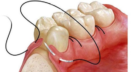 Gumele plastic - ambele realizate pe chirurgie lambou gingival (gingivoplastie) - dentară (gume) Gumele plastic - ambele realizate pe chirurgie lambou gingival (gingivoplastie) - Dental