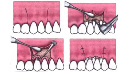 Gumele plastic - ambele realizate pe chirurgie lambou gingival (gingivoplastie) - Dental (operare) Gumele plastic - ambele realizate pe chirurgie lambou gingival (gingivoplastie) - Dental