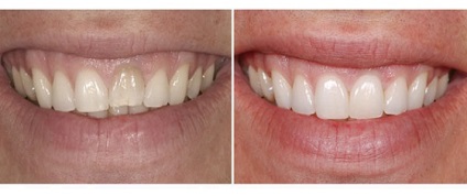 Gumele plastic - ambele realizate pe chirurgie lambou gingival (gingivoplastie) - dentară (gume de plastic) Gumele plastic - ambele realizate pe chirurgie lambou gingival (gingivoplastie) - Dental
