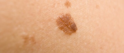 îndepărtarea plat brun mole, periculoase decât (plate) îndepărtarea mole brun plat decât periculos