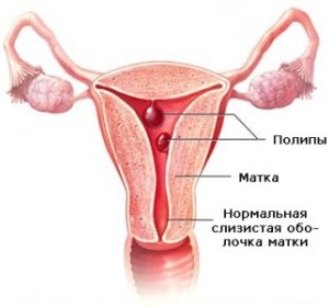 Polipii pe piele și corp - simptome, diagnostic si tratament