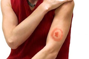 Traumele si dezvolta encefalita (căpușe, virale și alte forme) (encefalită) Traumele si dezvolta encefalita (căpușe, forme virale și altele)