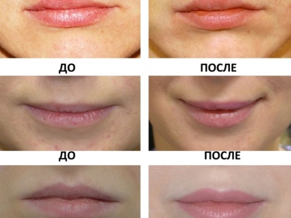 Procedura și recenzii lipofilling feței, pliurilor nazolabiale și în alte zone, înainte și după fotografii (lipofilling) Procedura și recenzii lipofilling feței, pliurilor nazolabiale și în alte zone, înainte și după fotografii