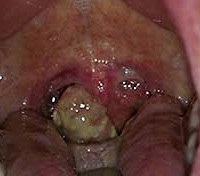 cancer hipofaringelui - cauze, simptome, diagnostic și tratament (hipofaringe) cancer hipofaringelui - cauze, simptome, diagnostic și tratament