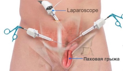 Perlele inghinala masculi cauze, tipuri și tratament (motive) Perlele inghinala masculi cauze, tipuri și tratament