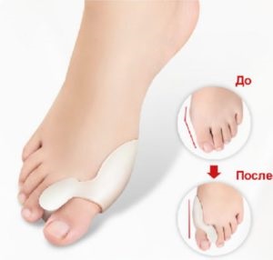 pad silicon pe degetul mare de la os (silicon) pad silicon pe degetul mare de piatra