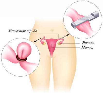 Sterilizarea ca metodă de contracepție (consecințele) Sterilizarea ca metodă de contracepție