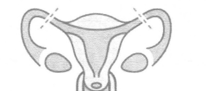 Sterilizarea ca metodă de contracepție (comentarii) Sterilizarea ca metodă de contracepție