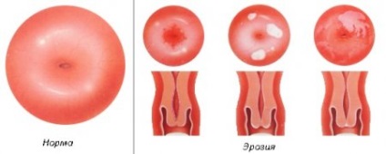 Stoletnik în ginecologie (mâncărime vaginale ardere) Agave în Ginecologie
